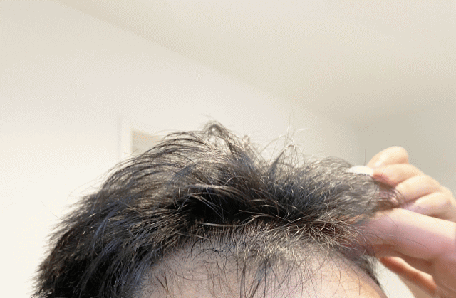 自毛植毛と人工毛植毛のメリット・デメリット